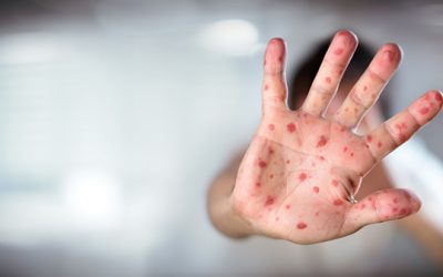 Measles Q & A