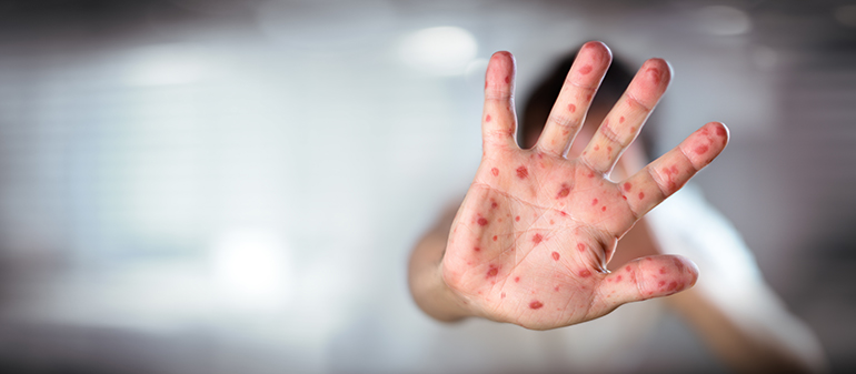 Measles Q & A